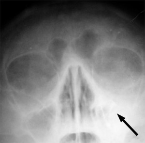 Røntgen kan være aktuelt i noen tilfeller. Bilde: wikipedia.no