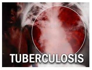 Tuberkulose