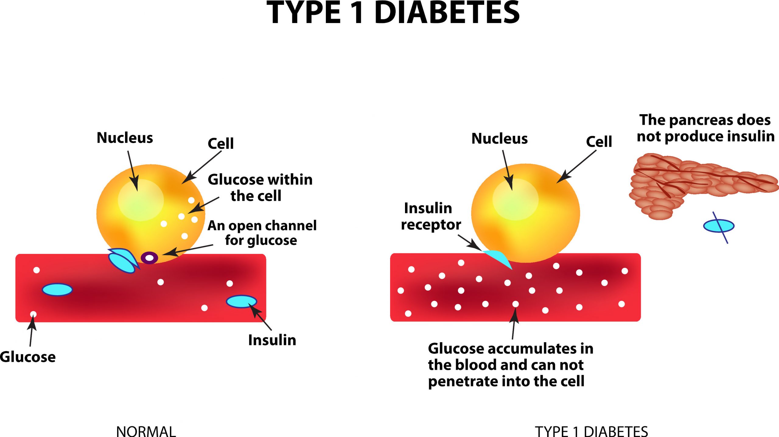 Ved diabetes type 1 fører nedsatt insulinsproduksjon til økt blodsukker, noe som kan påvirkes av kostholdet.