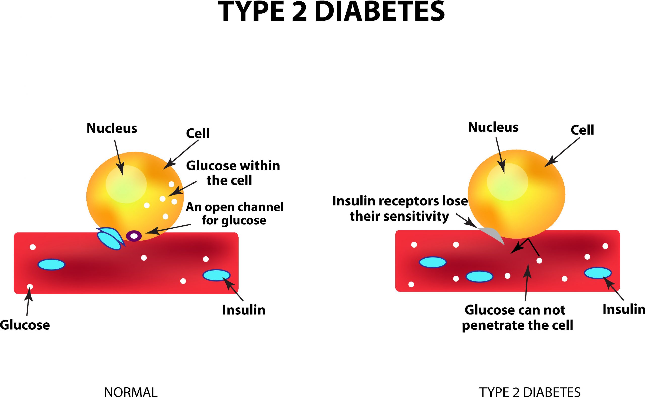 Ved diabetes type 2 vil insulinet miste sin effekt, noe som fører til overproduksjon og høyt blodsukker.