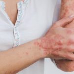 Kan kosthold hjelpe mot psoriasis?